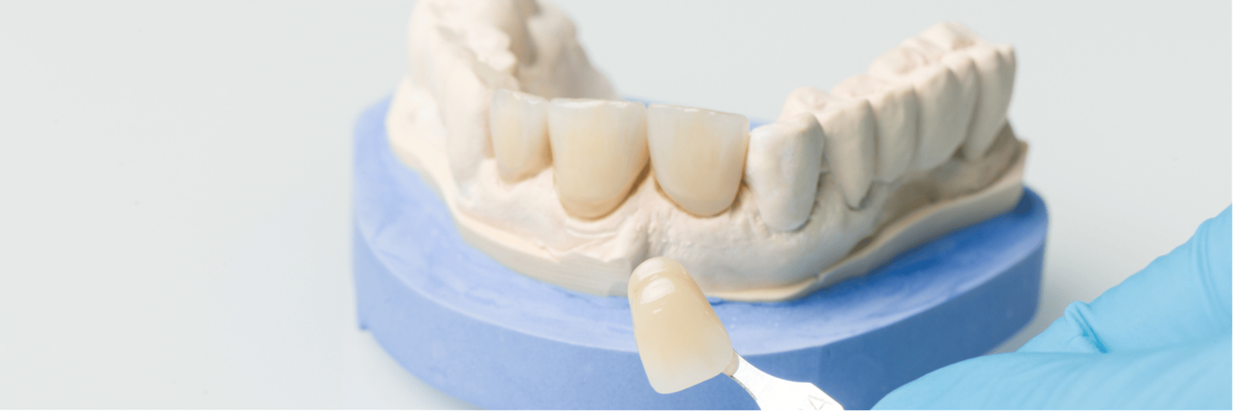 Crowns, Bridges & Onlays | Dentist