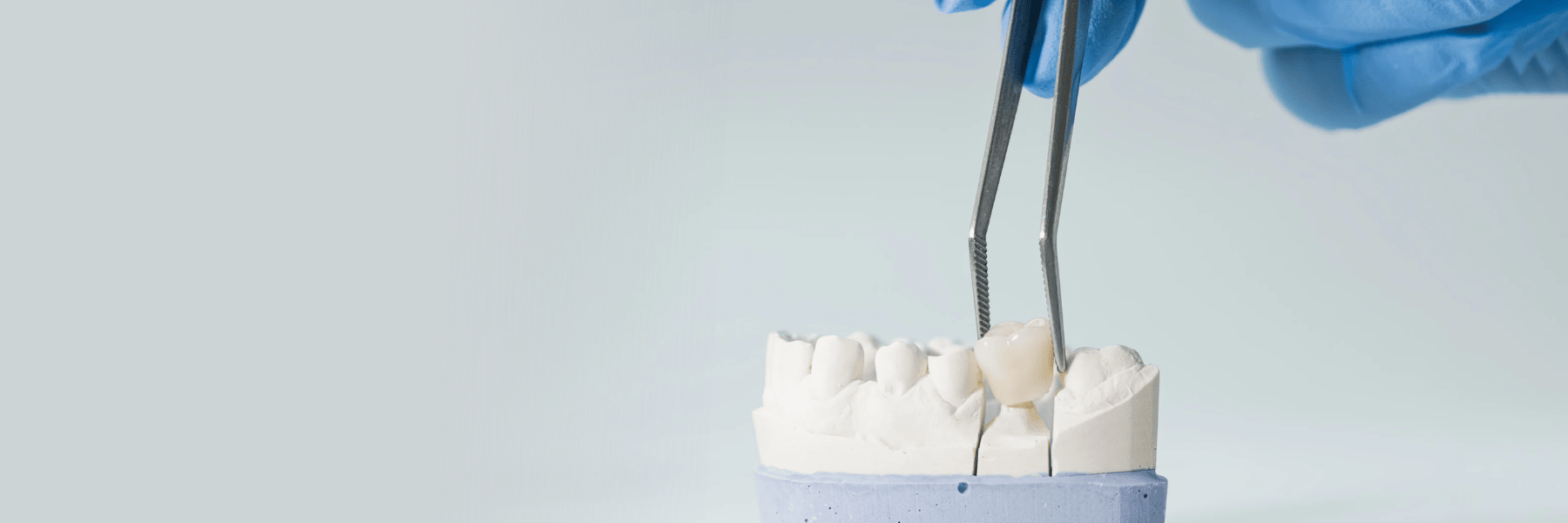 Crowns, Bridges & Onlays | Dentist