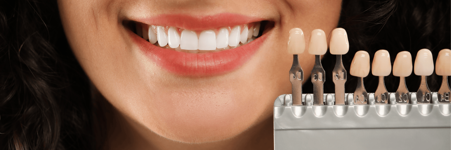 Porcelain Veneers | Dentist