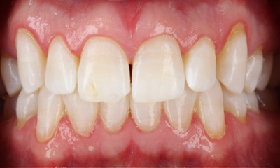 After treatment - KöR Whitening