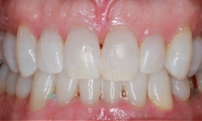 After treatment - KöR Whitening