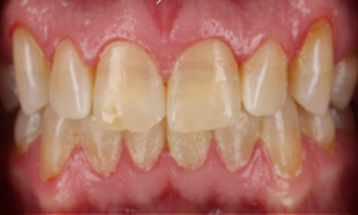 Before treatment - KöR Whitening