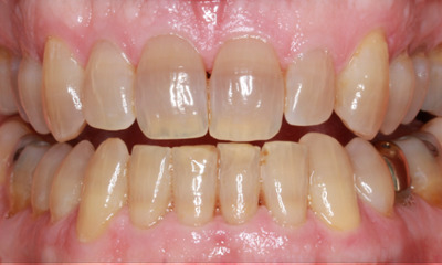 Before treatment - KöR Whitening